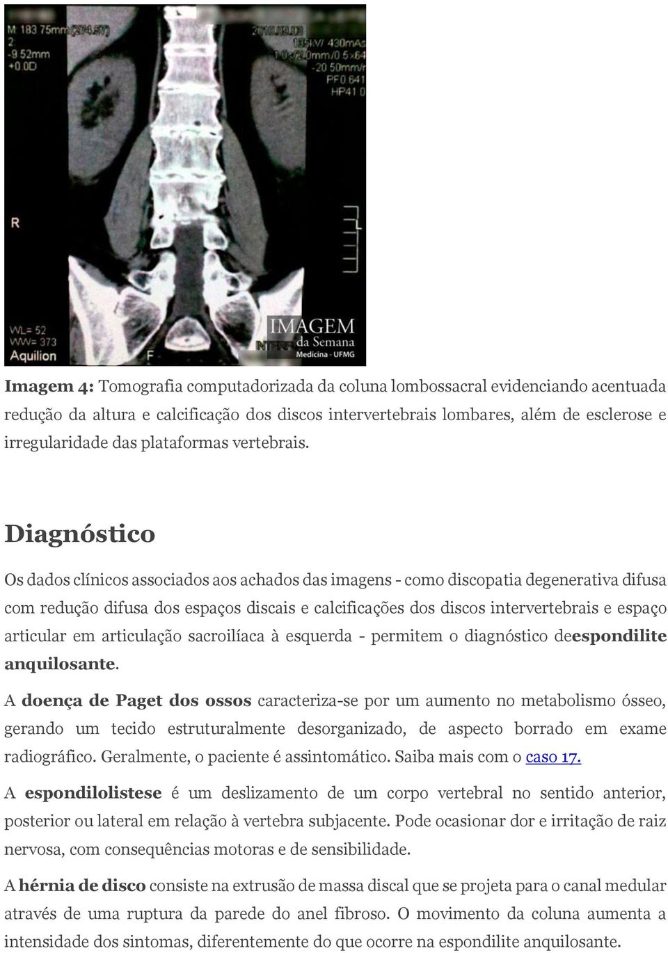 Diagnóstico Os dados clínicos associados aos achados das imagens - como discopatia degenerativa difusa com redução difusa dos espaços discais e calcificações dos discos intervertebrais e espaço