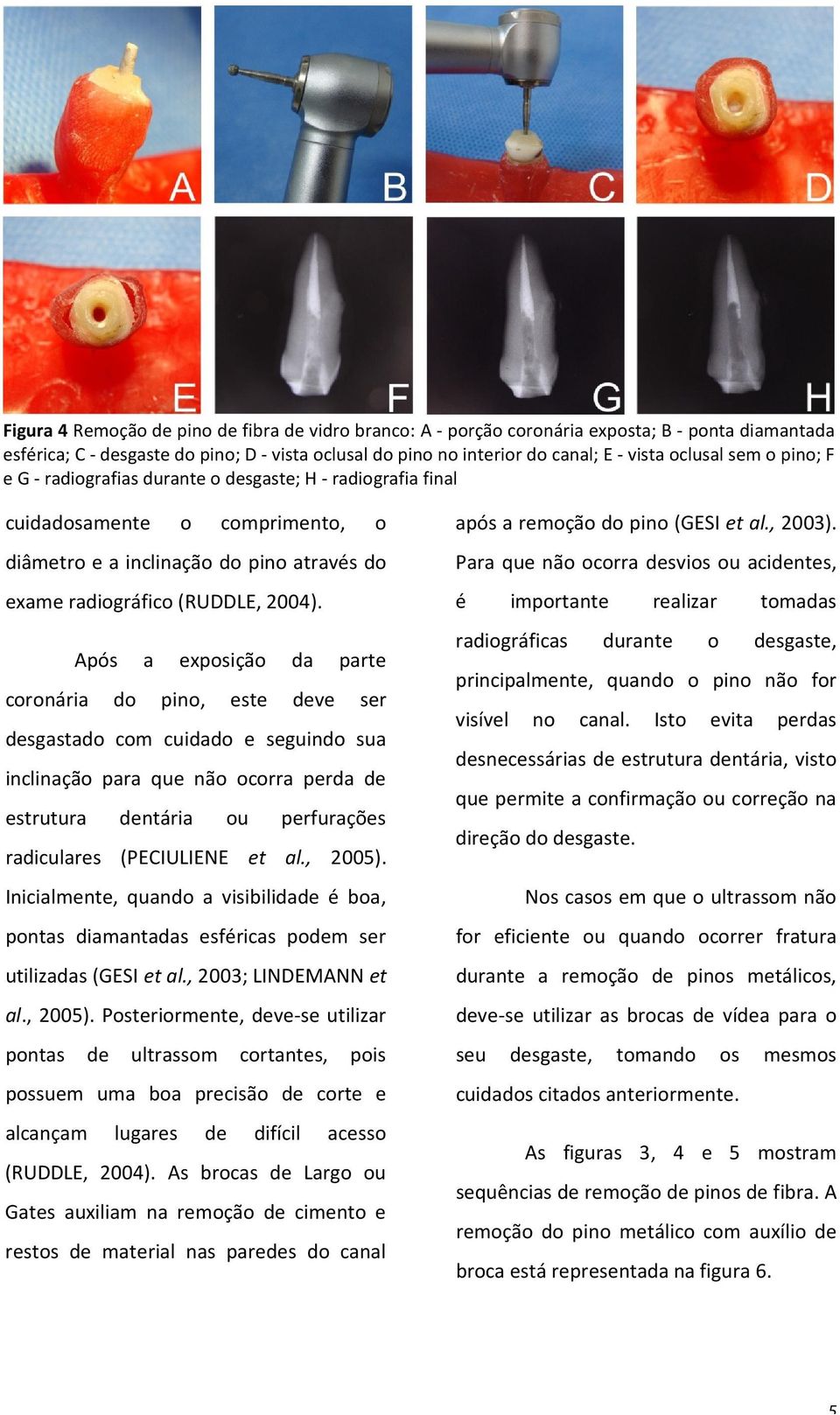 Após a exposição da parte coronária do pino, este deve ser desgastado com cuidado e seguindo sua inclinação para que não ocorra perda de estrutura dentária ou perfurações radiculares (PECIULIENE et