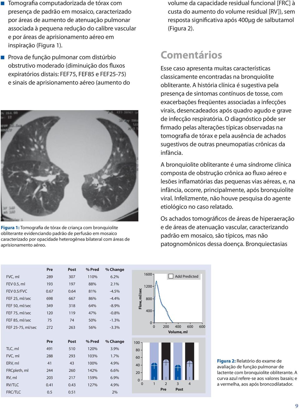 Prova de função pulmonar com distúrbio obstrutivo moderado (diminuição dos fluxos expiratórios distais: FEF75, FEF85 e FEF25-75) e sinais de aprisionamento aéreo (aumento do Figura 1: Tomografia de