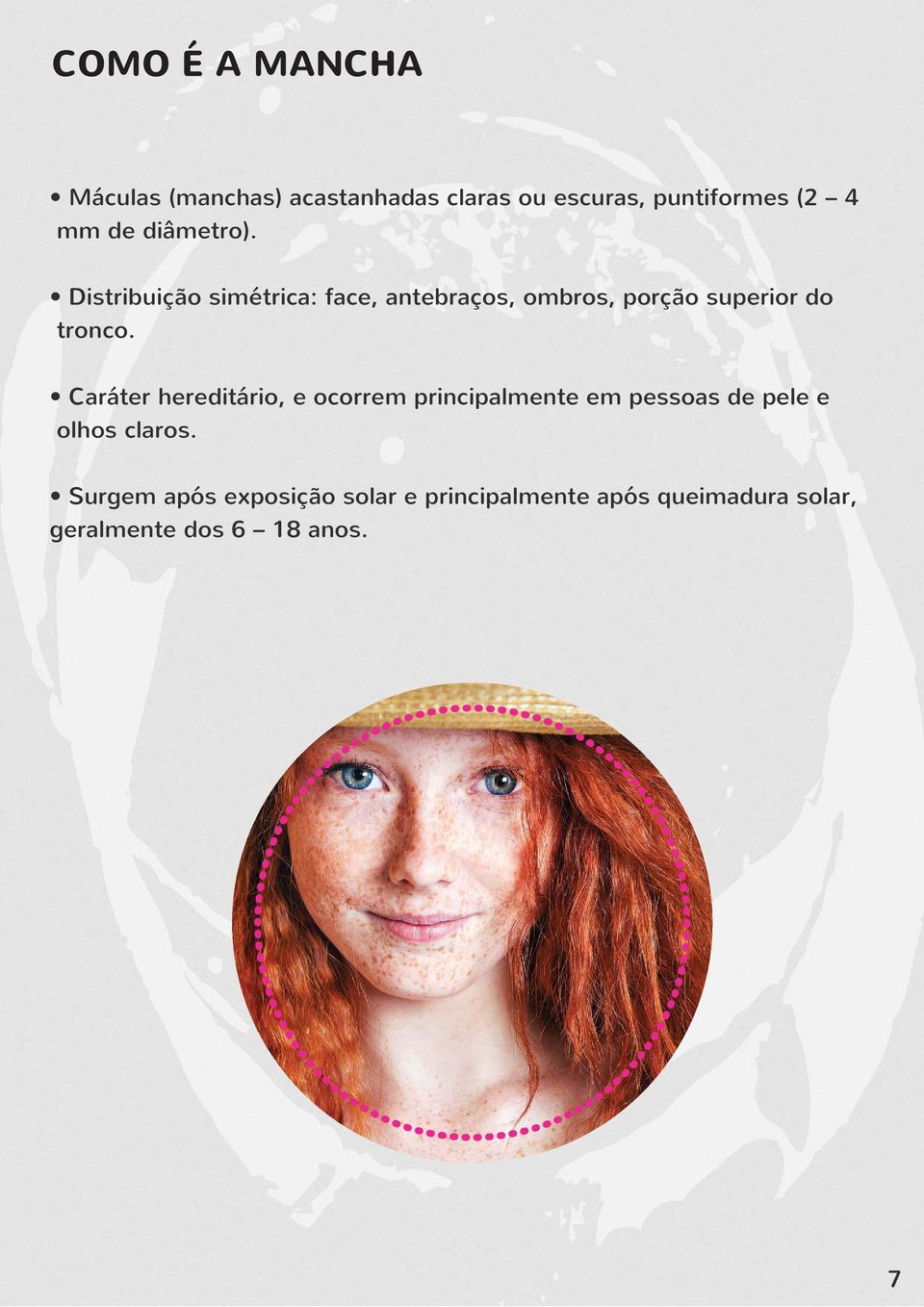 Caráter hereditário, e ocorrem principalmente em pessoas de pele e olhos claros.