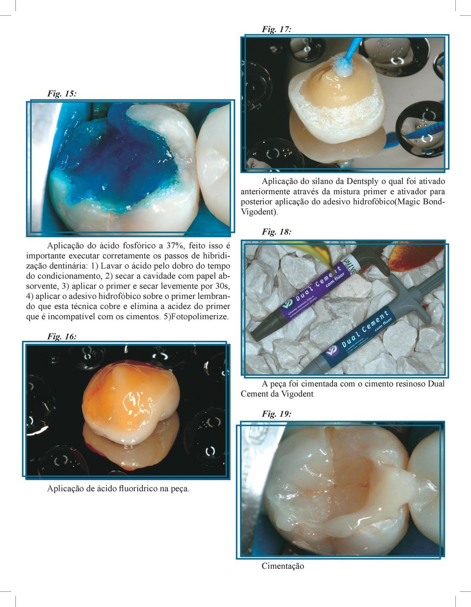 secar a cavidade com papel absorvente, 3) aplicar o primer e secar levemente por 30s, 4) aplicar o adesivo hidrofóbico sobre o primer lembrando que esta técnica cobre e elimina a acidez do