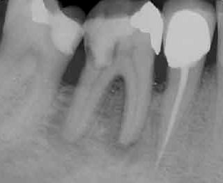 Pericementite: é o espessamento anormal do ligamento periodontal devido a necrose e infecção pulpar com invasão dos tecidos periapicais.