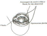 Amputação de Syme (desarticulação do