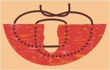escolha do tipo TENSÃO MODERADA E APOSIÇÃO PERTO-LONGE-LONGE-PERTO LONGE-PERTO-PERTO-LONGE combinação de sutura de aposição com sutura de tensão; um movimento de espiral Indicada quando a pele requer