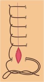 escolha do tipo SUTURA CONTÍNUA ANCORADA (Ford ou Reverdin) modificação da sutura contínua simples; a cada passagem através dos tecidos, o fio é unido ao ponto passado anteriormente a vantagem