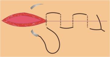 escolha do tipo SUTURA CONTÍNUA EM U (de colchoeiro ) pode ser usada na pele quando houver indicação para sutura contínua e um certo grau de eversão a sutura inicia-se com um ponto isolado simples,