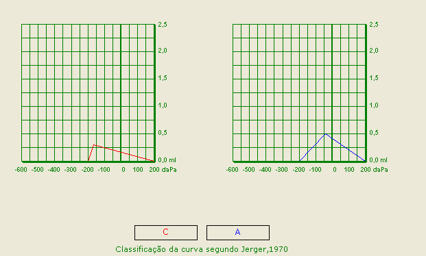 14 Figura 4. Resultados de timpanogramas normal à esquerda (curva tipo A) e alterado à direita (curva tipo C), segundo a classificação de Jerger, (1970).