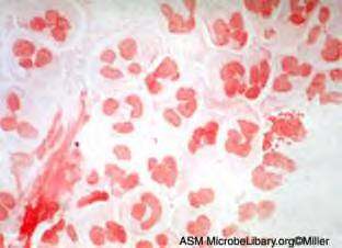 células inflamatórias e flora bacteriana multipla Amostra com raras