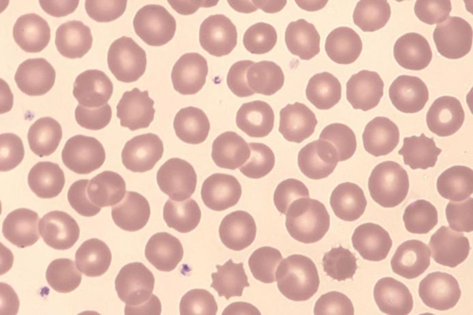 Hemácia em bolha (Blister cell) São células nas quais a hemoglobina parece