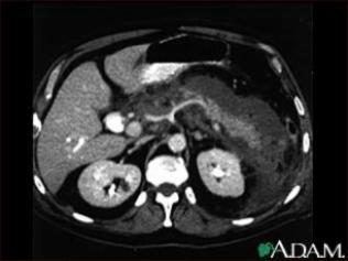 Tomografia Computadorizada (TC) Pancreatite crônica