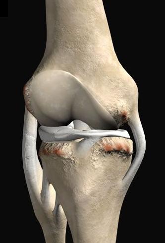 A artrose é gerada por mau estabilidade da articulação.