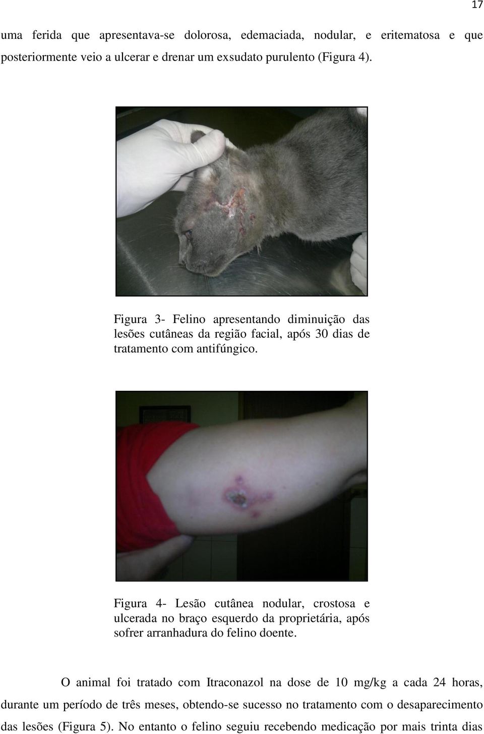 Figura 4- Lesão cutânea nodular, crostosa e ulcerada no braço esquerdo da proprietária, após sofrer arranhadura do felino doente.
