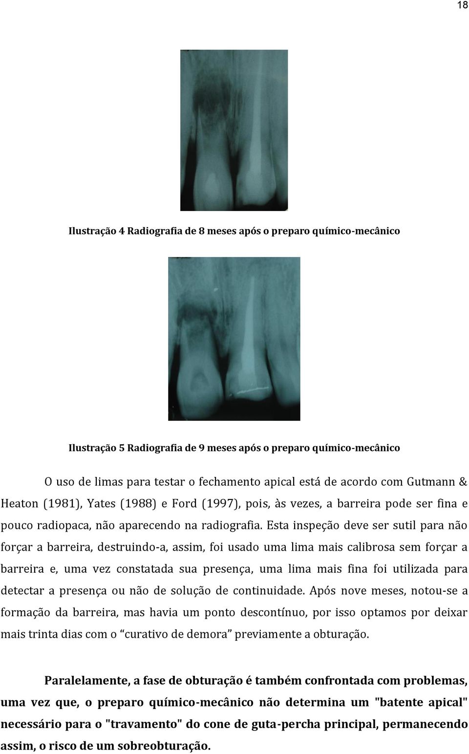 Esta inspeção deve ser sutil para não forçar a barreira, destruindo-a, assim, foi usado uma lima mais calibrosa sem forçar a barreira e, uma vez constatada sua presença, uma lima mais fina foi