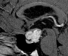 DIAGNÓSTICO DE CRANIOFARINGIOMA ATRAVÉS DA TOMOGRAFIA COMPUTADORIZADA E RESSONÂNCIA MAGNÉTICA Figura 2 - Craniofaringioma - TC em plano coronal demonstrando lesão selar e suprasselar apresentando