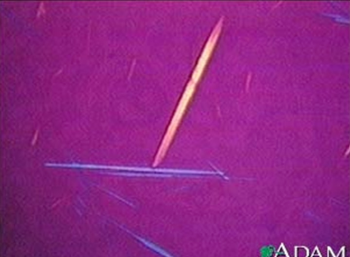 DIAGNÓSTICO LABORATORIAL Punção do liquido articular, que revela cristais típicos de urato monossódico, que ao serem analisados em microscópio de luz polarizada revelam cristais