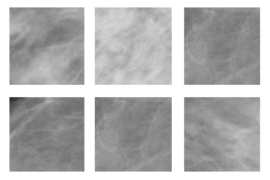 classificar lesões em mamografias, a fim de evidenciar informações que caracterizem melhor a imagem é utilizada a transformada wavelet, obtendo uma acurácia de 79,17% no método LBP para a