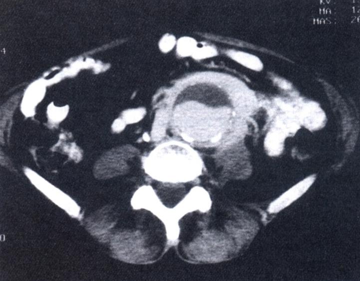 Sintomático Tratamento - Cirurgia