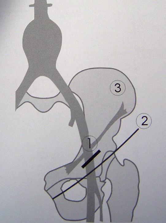 Técnica: Acesso femoral; Arteriografia intraoperatória; Posicionamento da