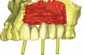 vestíbulo-medial no local das futuras peças dentárias. Desta forma, após a realização de uma tomografia computorizada de feixe-cónico foi possível observar e estudar o posicionamento dos implantes.