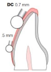 A diferença do diâmetro total e do diâmetro da ponta da outra broca a usar deverá ser de 1,0mm para que, durante o desgaste em profundidade com a broca paralela ao longo eixo do dente ou com uma