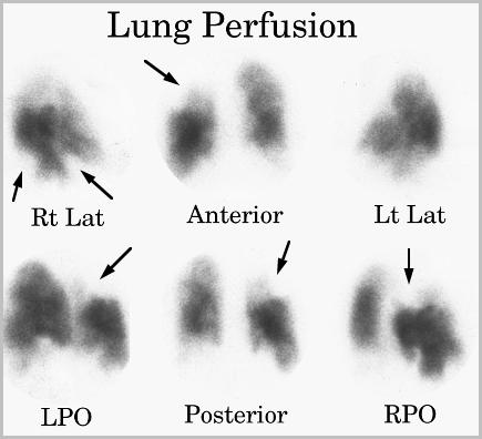 Embolismo Pulmonar e Cintilografia de Ventilação