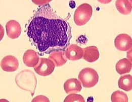 Ainda, a revisão microscópica da lâmina manual mostrou a presença de células com cromatina imatura contendo nucléolos aberrantes e citoplasma azul escasso, semelhante a BLASTOS.