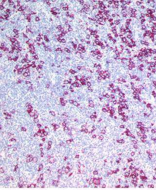 Nodular lymphocyte predominant Hodgkin's disease