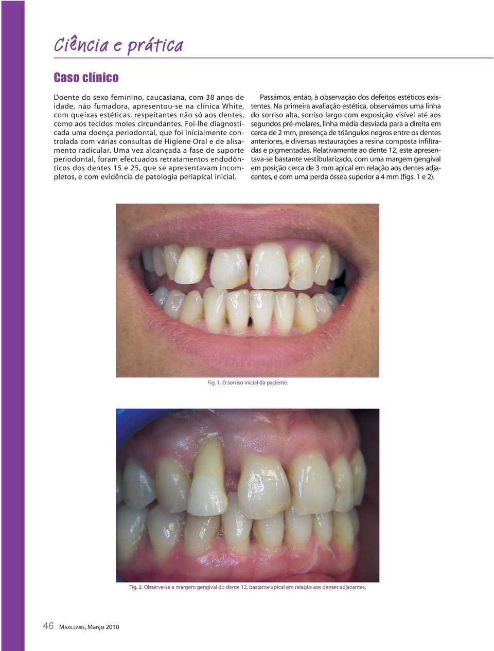 Uma vez alcançada a fase de suporte periodontal, foram efectuados retratamentos endodônticos dos dentes 15 e 25, que se apresentavam incompletos, e com evidência de patologia periapical inicial.