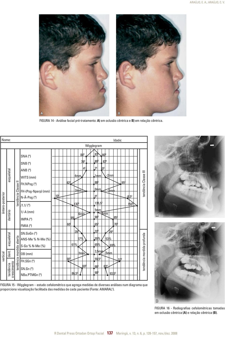 esqueletal dentário esqueletal tendência mordida aberta tendência Classe II ANB (º) WITS (mm) FH.NPog (º) FH-(Pog-Nperp) (mm) N-Â-Pog (º) /1.1/ (º) 1/-A (mm) IMPA (º) FMIA (º) SN.