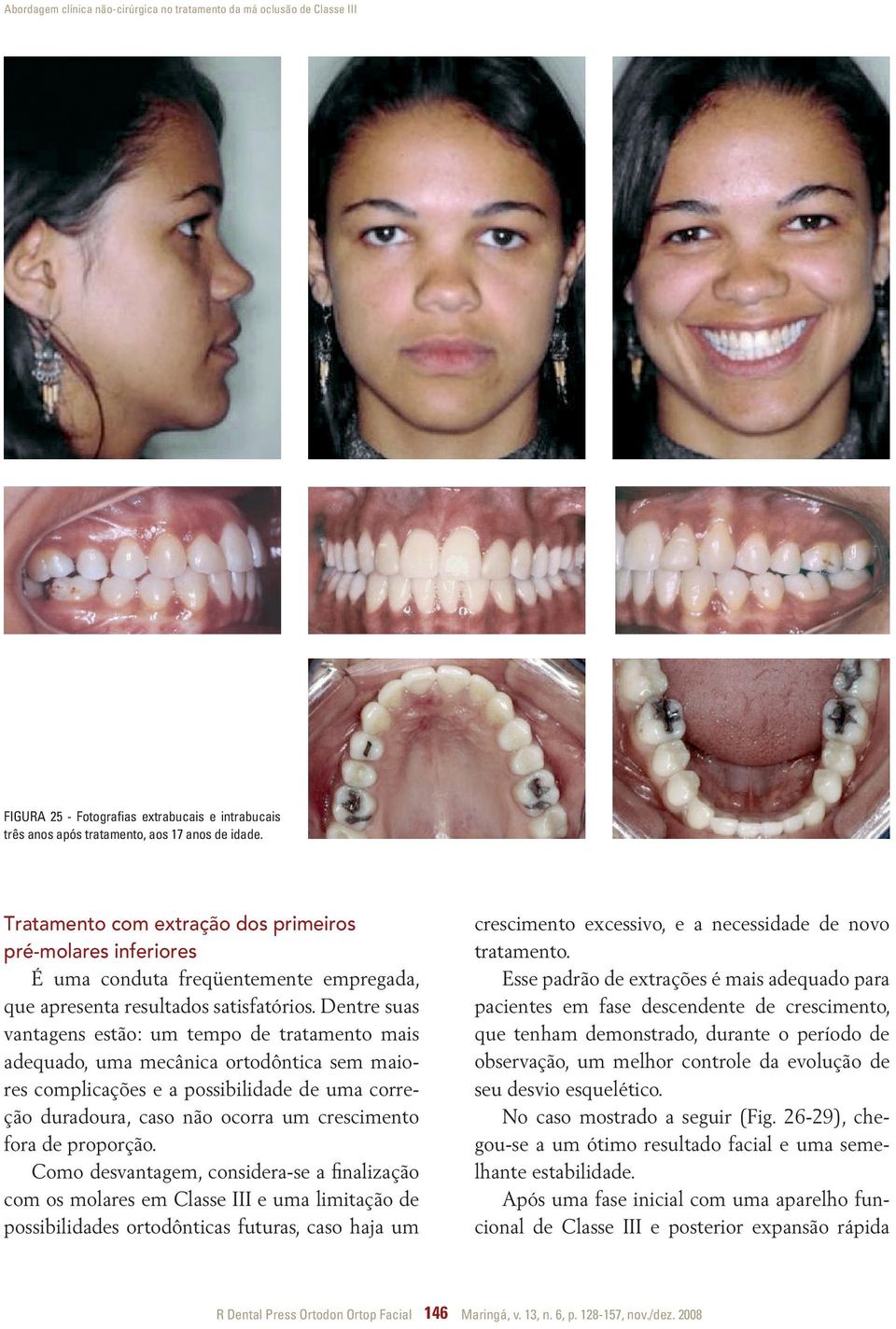 Dentre suas vantagens estão: um tempo de tratamento mais adequado, uma mecânica ortodôntica sem maiores complicações e a possibilidade de uma correção duradoura, caso não ocorra um crescimento fora