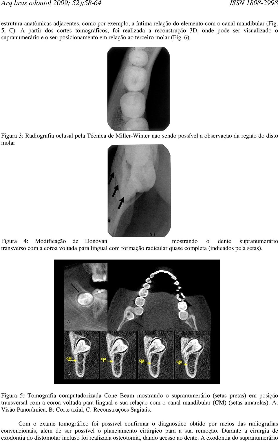 Figura 3: Radiografia oclusal pela Técnica de Miller-Winter não sendo possível a observação da região do disto molar Figura 4: Modificação de Donovan mostrando o dente supranumerário transverso com a