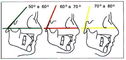 Inclinação do Plano Mandibular (M1) M-NO Fator 3 ( componente da estrutura FACIAL) Fig. 7 Inclinação horizontal: cor verde. Neutro: cor vermelho.