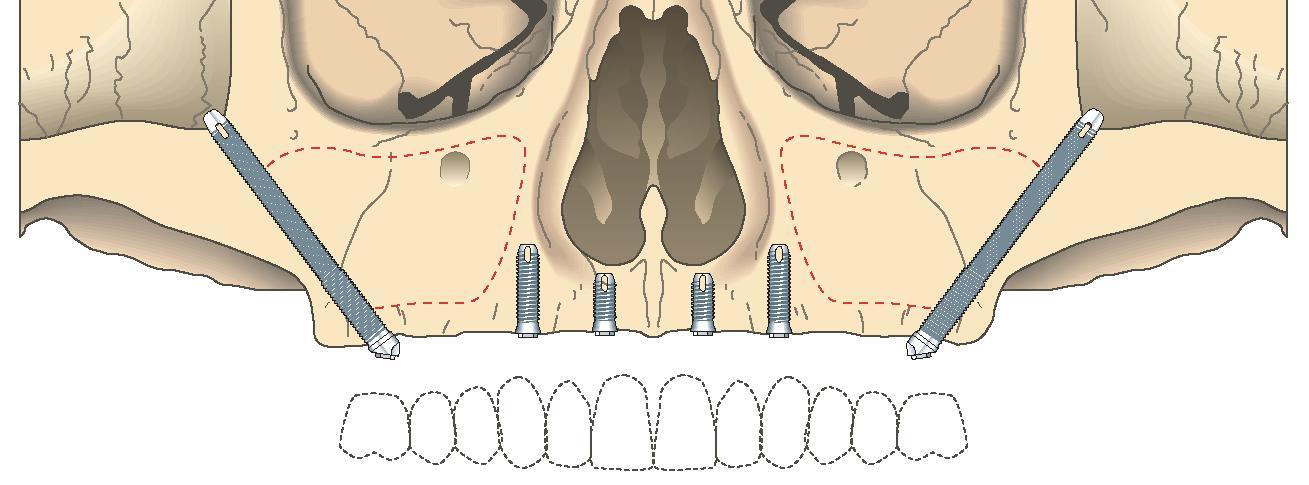 9 Com o auxílio de um afastador desenhado para este procedimento, é removida a gaze do seio maxilar e realizada a seqüência de perfurações, buscando a emergência das plataformas dos implantes nas