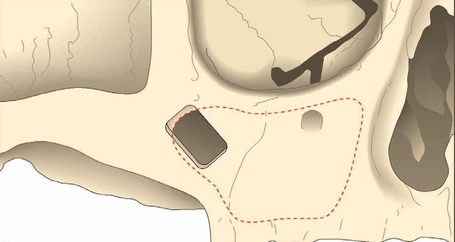 8 Figura 1 - Incisão inicial (Branemark, 2004) Um retalho palatino é erguido para se expor o rebordo residual é realizado, assim como a dissecação da mucosa nasal, para prover uma compreensão da