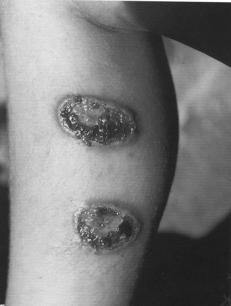 Doença no homem Leishmaniose tegumentar forma cutânea: lesões nodulares não ulcerativas lesões ulcerosas em botão forma mucocutânea: lesões ulcerativas e
