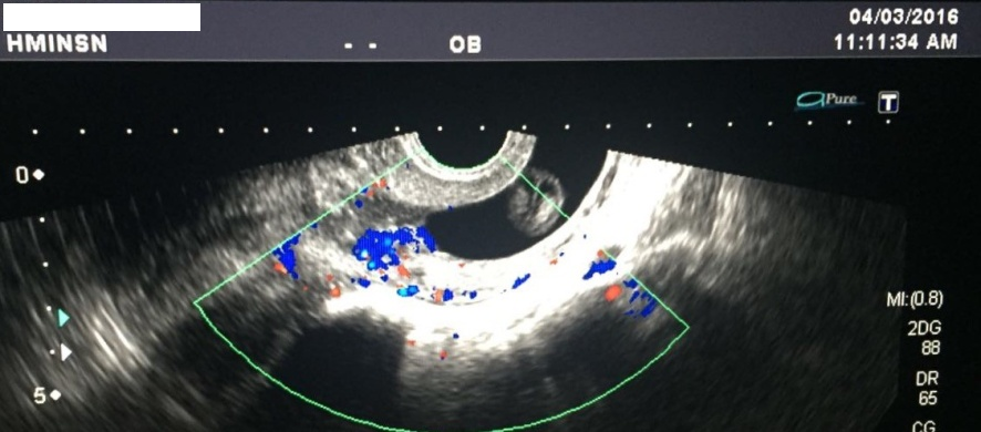 56# 6 RELATO DE CASO Paciente, 42 anos, deu entrada no Pronto Socorro da cidade com queixas de sangramento transvaginal vivo de moderada intensidade, dor tipo cólicas em baixo ventre, tonturas e