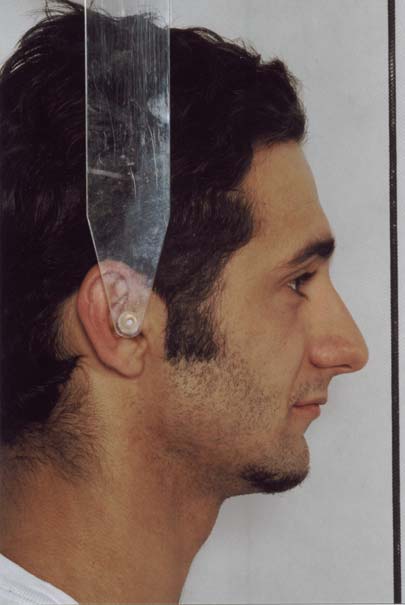 37 Padrão II: indivíduos apresentando a relação sagital com degrau distal entre maxila e mandíbula, com protusão maxilar e/ou
