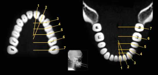 Capítulo 2 55 BRAQUIFACIAL MESOFACIAL DOLICOFACIAL Fig. 2.6 - Incisivos centrais. Fig. 2.7 - Incisivos laterais.