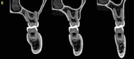 56 Ortodontia - Cabrera & Cabrera BRAQUIFACIAL MESOFACIAL DOLICOFACIAL Fig. 2.11 - Primeiros Molares Fig. 2.12 - Segundos molares.