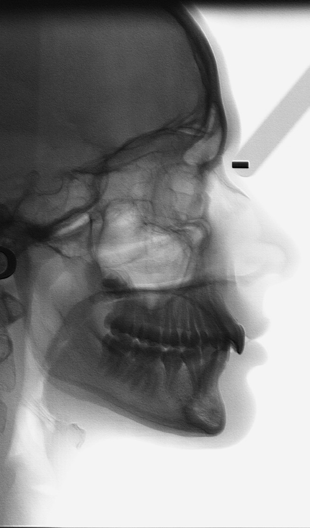 Zanelato R Figura 52, 53: Modelos de estudo em vistas oclusais. Figura 54: Radiografia panorâmica inicial. Perfil esquelético e relação das bases SNA... 82 SNB... 80 ANB.