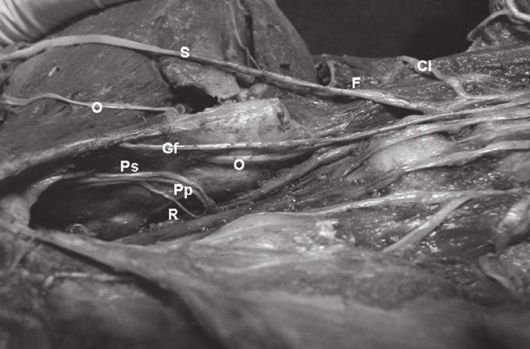 406 Figura 1 - Fotografia evidenciando a emergência dos nervos unissegmentares Ílio-hipogástrico (IH L 1 ), Ílio-inguinal (II L 2 ) e Cutâneo Femoral Lateral (Cl L 3 ) Cranial e Ílio-hipogástrico