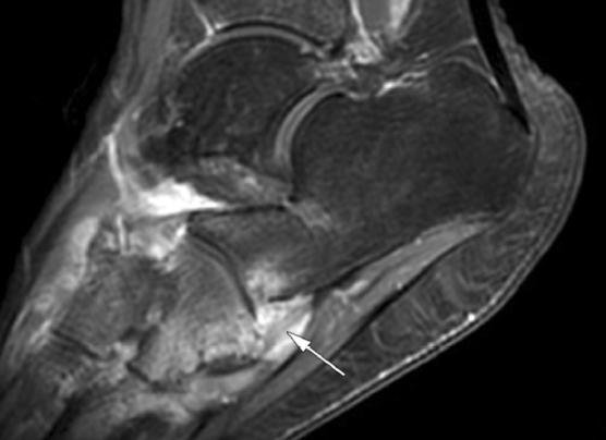 Annals of the Rheumatic Diseases 2007 MRI of enthesitis of the appendicular skeleton in spondyloarthritis Iris Eshed et al.