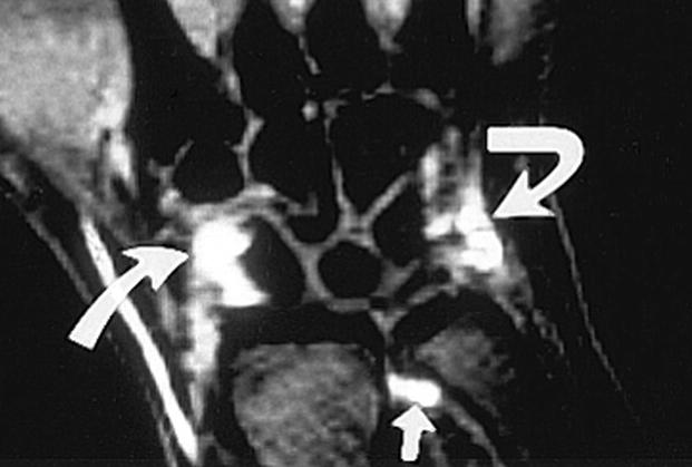 Aplicações da saturação de gordura: EROSÕES Pitfalls in scoring MR images of rheumatoid arthritis wrist and metacarpophalangeal joints Ann Rheum Dis.