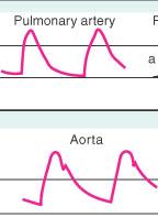 Artéria Pulmonar e Aorta Uma curva sistólica coincidindo com o esvaziamento ventricular À medida que a ejeção ventricular termina, a pressão na respectiva artéria começa a cair Ocorre uma incisura