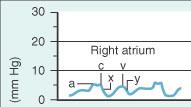 Curva de AD Onda a Sístole atrial Em seguida da onda P do ECG Amplitude : contratilidade de AD e resistência ao enchimento de VD Descendente x Relaxamento do átrio e deslocamento para baixo do anel