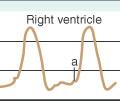 Curva de VD Diástole Enchimento rápido (pequeno) Enchimento lento Onda a - coincide com a sístole atrial Sístole Formato triangular Subida e queda da pressão durante a