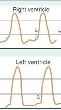 Curva de VE Semelhante ao VD diferença é a magnitude Menos triangular Subida e descida mais rápidas Pressões habitualmente