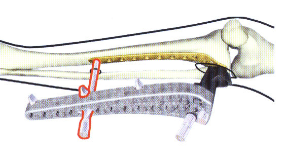 Inserção da Placa LISS Deslize a placa LISS na direção distal, com o final da parte distal em constante contato com o osso. A posição do final proximal da placa deve estar sobre o côndilo lateral.