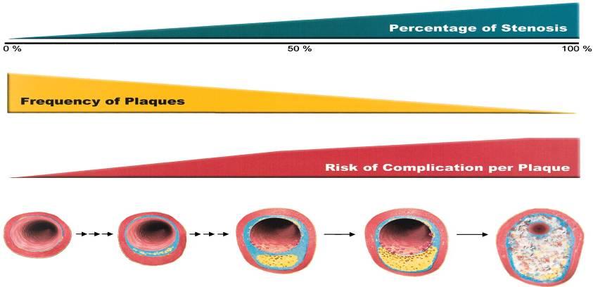 Incidência das Lesões Intermediárias Correlation Among Frequency of Plaques, Percentage of Stenosis and Risk of Complication