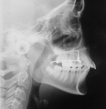 Papadopoulos, M. A. Figura 8 - Telerradiografia evidenciando que a força de distalização do MISDS passa pelo centro de resistência dos molares.
